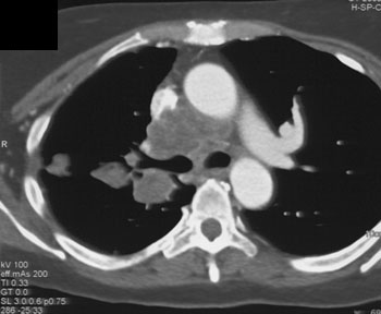 cardiac 64 mdct