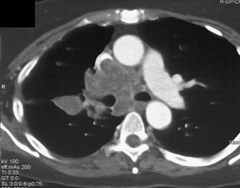 cardiac 64 mdct