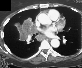 cardiac 64 mdct