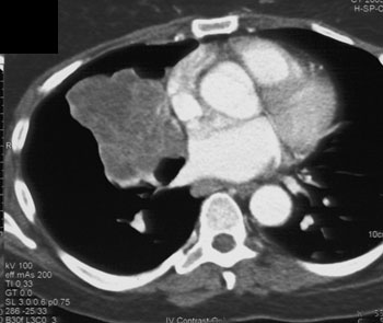 cardiac 64 mdct