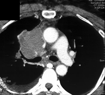 cardiac 64 mdct