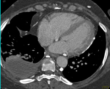 cardiac 64 mdct