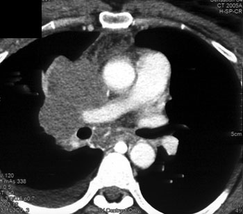 cardiac 64 mdct