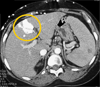 cardiac 64 mdct