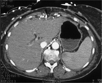 cardiac 64 mdct