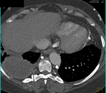 cardiac 64 mdct