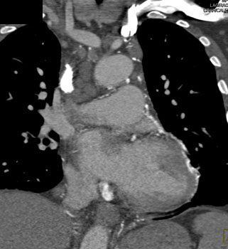 cardiac 64 mdct