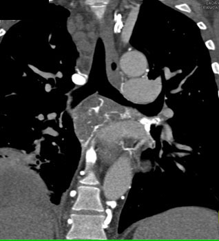 cardiac 64 mdct