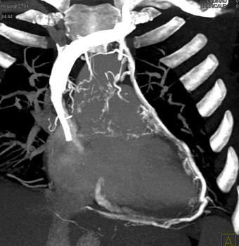 cardiac 64 mdct