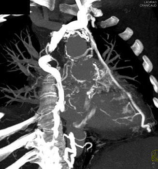 cardiac 64 mdct