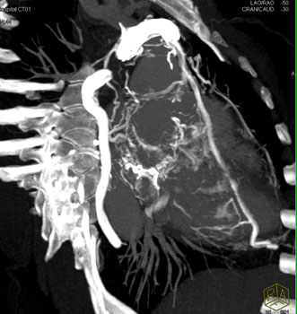 cardiac 64 mdct