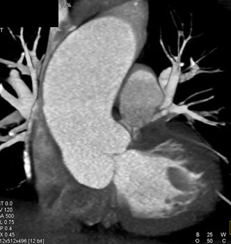 cardiac 64 mdct