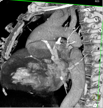 cardiac 64 mdct