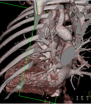 cardiac 64 mdct