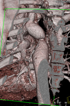 cardiac 64 mdct