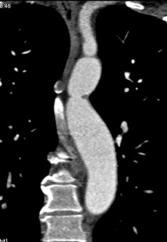 cardiac 64 mdct