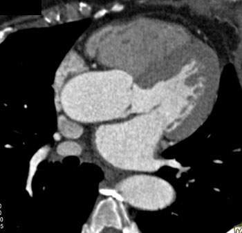 cardiac 64 mdct