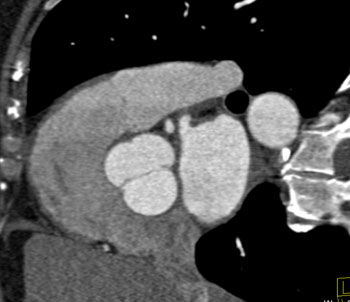 cardiac 64 mdct