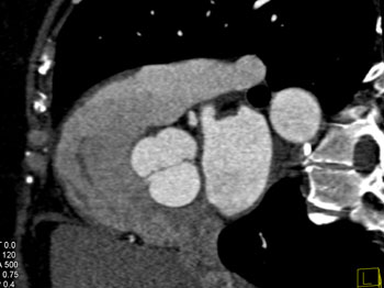 cardiac 64 mdct