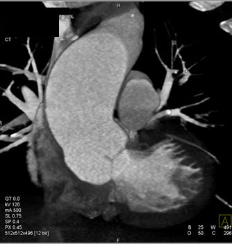 cardiac 64 mdct