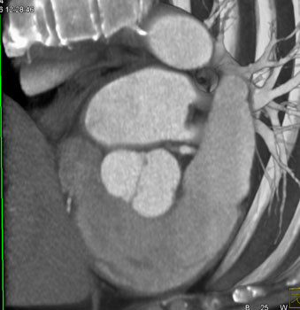 cardiac 64 mdct