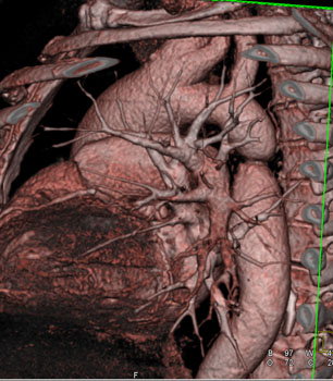 cardiac 64 mdct