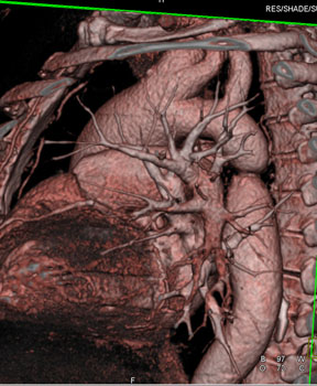 cardiac 64 mdct