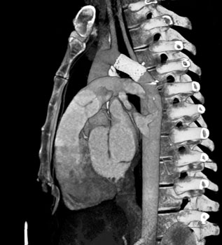 cardiac 64 mdct