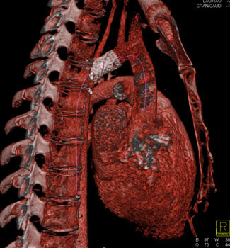 cardiac 64 mdct