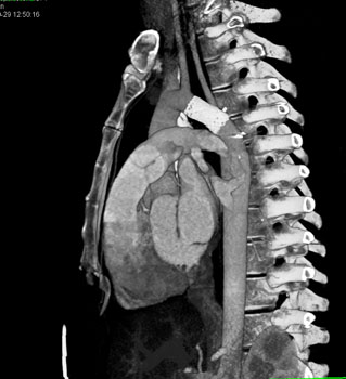 cardiac 64 mdct