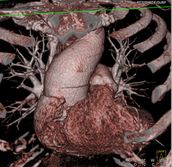 cardiac 64 mdct