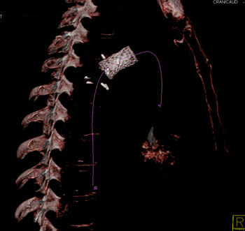 cardiac 64 mdct