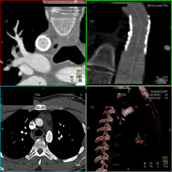 cardiac 64 mdct