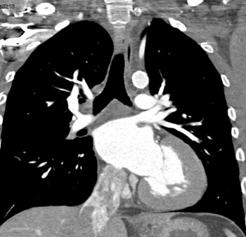 cardiac 64 mdct