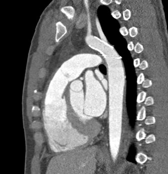 cardiac 64 mdct