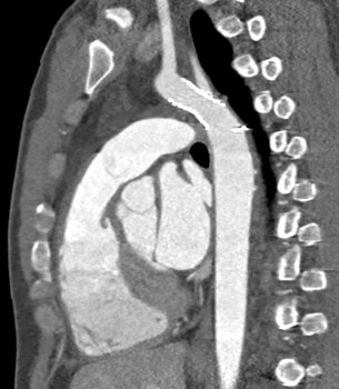 cardiac 64 mdct