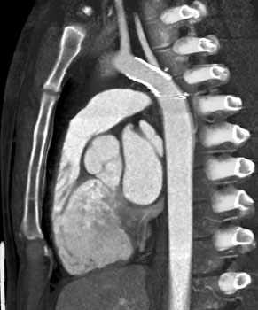 cardiac 64 mdct