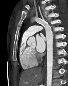 cardiac 64 mdct