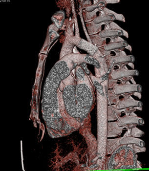 cardiac 64 mdct