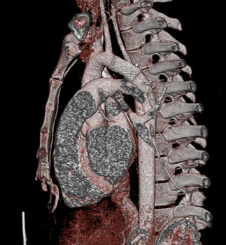 cardiac 64 mdct