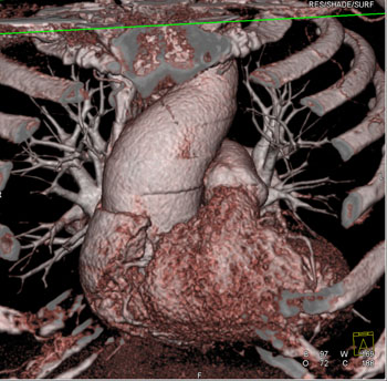 cardiac 64 mdct