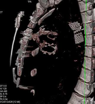 cardiac 64 mdct