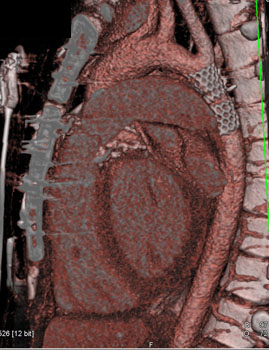 cardiac 64 mdct