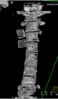 cardiac 64 mdct