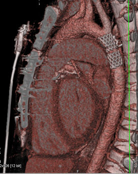 cardiac 64 mdct