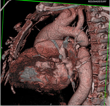 cardiac 64 mdct