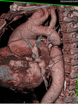 cardiac 64 mdct