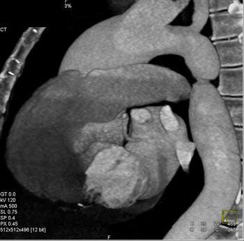 cardiac 64 mdct