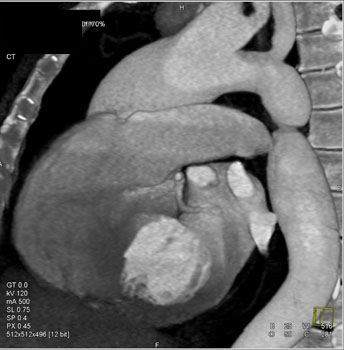 cardiac 64 mdct