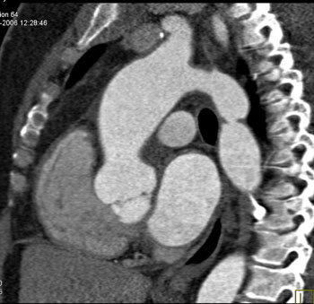 cardiac 64 mdct